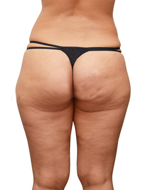 Cellulite. What is cellulite?