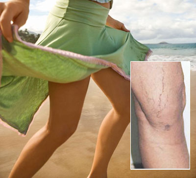 I’ve Got Spider Veins – and pre-beach panic! What Do I DO?