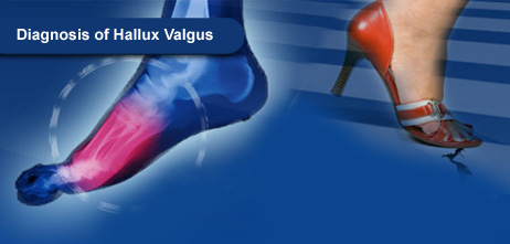 Diagnosis of Hallux Valgus. Pressure Mapping Systems.